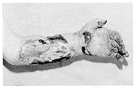Fig. 8 - The same injury after HBO treatment. Note dry eschar and clear rapid spontaneous demarcation