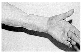 Fig. 9 -The same forearm after completion of treatment
