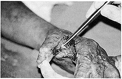 Fig. 2 - Liberation de la premire commissure tendue  l~adducteur du premier, suivie dune etcision de 1'ancienne ereffe dorsale rtracte. tnolvse et arthrolvse des 1fIP.