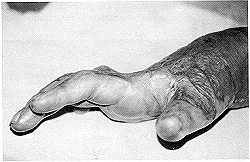 Fig. 7 - Squelles  la main droitc: rtraction dorsale. Aucune pincc pouce-index ni prhension.