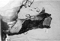 Fig. 8 - Excision de placard rtractile. Tnoly5e, arthrolyse + embrochage prosseux (intrinsque+). Leve + mice en place d'un lambeau top