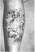 Fig. 1a - Second-degree superficial