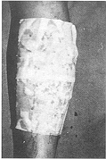 Fig. 1b - Wond covered with