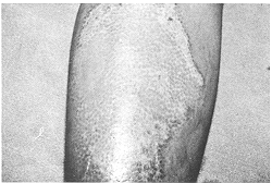 Fig. lc - Healed wound after 10 days with only two