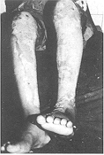 Fig. 2a - Second-degree deep burns in both
