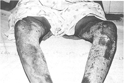Fig. 2c - The right leg was dressed with Micromat and changed every 72 h and the left leg with 1 % silver sulphadiazine cream. The left leg had to be dressed almost every day because of soakage. 