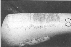 Fig. 1 - Split thickness skin graft harvested from left thigh by Watson's knife.