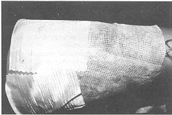 Fig. 3b - The proximal half of the donor site was dressed with Micromat and<br>
            the distal portion with `Fairlie' (Johnson & Johnson).