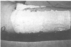 Fig. 3c - Both legs
            healed at the same time after 24 days.