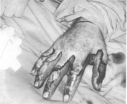 Fig. 1a - Deep dermal burn on dorsurn of right hand on operating table before tangential excision.