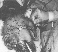 Fig. 1c - The sheet of split-thickness skin graft applied after secure haemostasis.