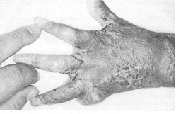 Fig. 2 - One of for hands seen on follow-up for interdigital web space
            correction.