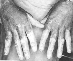 Fig. 3a - Dorsum of hand presenting almost normal look and feel.