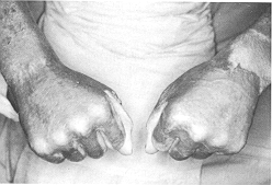 Fig. 3b - Normal function and almost full flexion and extension, with good
            elasticity of skin graft.