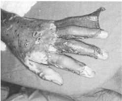 Fig. 4a - Hand with skin graft applied before on the dorsum but not on the
            fingers. Cracking, blistering, and delayed healing over the fingers, necessitating
            grafting. The graft is seen after application to the fingers after dermabrasion on the
            surface