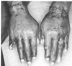 Fig. 4b - The two hands seen on 6-month follow-up. Good function and stable,
            secure healing with only mild hypertrophic scarring, flattening with time.