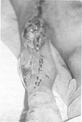 fig 1 - Perte de substance exposant les epiphyses superieures des deux os de 1'avant-bras et Farticulation du coude qui est ouverte