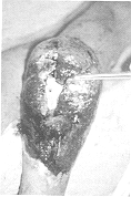 Fig. 2 - Perte de substance brachiale associee et tracee du lambeau antebrachial.