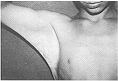 Fig. 1 - Bride axiliare, aspect préopératorie, face
