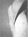 Fig. 2 - Bride axiliare, aspect preopératorie, profil.