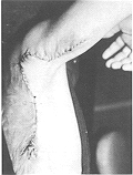Fig. 3 - Bride axillaire, aspect postoperatoire immediat.