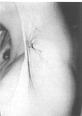 Fig. 5 - Bride, axillaire, schema de la plastie en IC.