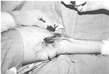 Fig. 6 - Bride axillaire, vue perioperatoire.