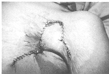 Fig. 7 - Bride axillaire, vue postoperatoire.