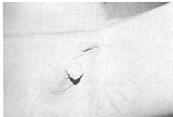 Fig. 8 - Bride inguinale.