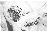 Fig. 9 -  Bride inguinale, vue perioperatoire Rotation du lambeau.