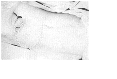 Fig. 10 - Bride inguinale, vue postoperatoire immediate.