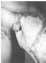 Fig. 11 - Bride inguinale,vuepostoperatoire.