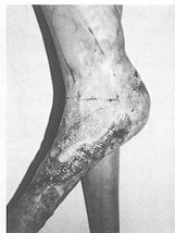 Fig. 12 - Bride poplitee, dessin de la plastie en IC, vue
pre-operatoire.
