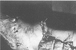 Fig. 13 - Bride poplitee, aspect post-operatoire immediat,
profil.