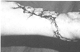 Fig. 14 - Bridepoplitée,aspectpostpost-operatoire immediat,faux profil.