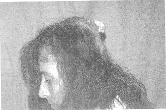 Fig. 1 - Pre-operative photograph of patient