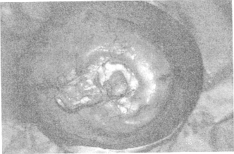 Fig. 2 - Pre-operative view of Marjolin's ulcer