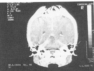 Fig. 3 - CT scan showing bone destruction