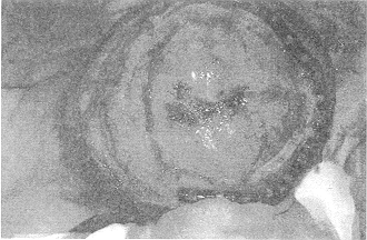 Fig. 4 - Intra-operative photograph of patient