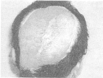Fig. 5 - Latissimus dorsi muscle used to