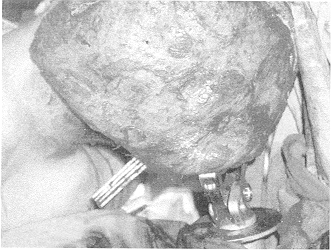 Fig. 6 - Final result, 4 months after