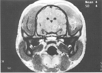 Fig. 1 - The cerebral sulci, cracks, cisterns, and ventricles of the brain appeared normal at PBH 6 in glucose solution group (Ti-weighted MRI, coronal section). 