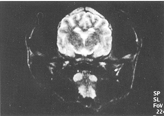 Fig. 2 - The boundary line between grey matter and white matter appeared clearly, and there was no abnormal cerebral signal at PBH 6 in the glucose solution group (T2-weighted MRI, coronal section).