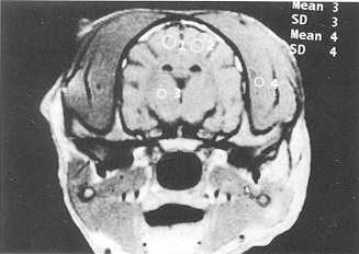 Fig. 3 - The cerebral sulci and cracks became flat and tended to disappear; the cerebral cisterns and ventricles were narrowed and blocked at PBH 24 in the glucose solution group (Ti-weighted MRI, coronal section).