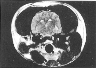 Fig. 4 - It was difficult to distinguish grey matter from white matter at the boundary line; the brain signal was not uniform at PBH 24 in the glucose solution group (T2-weighted MRI, coronal section).