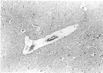Fig. 5 - Evident enlargement of the perivascular gaps and a compressed capillary lumen were found at PBH 24 in the glucose solution group (LM, HE x 400)