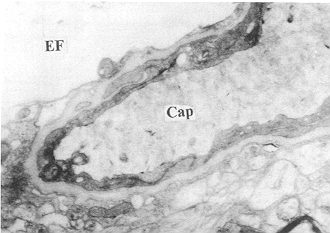 Fig. 6 - Swelling of mitochondria of capillary endothelia and vacuolation of perivascular end foot were observed at PBH 24 in the glucose solution group (TEM x 8000).
