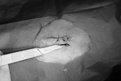 Fig. 1Biopsy from patient (note the dimensions).