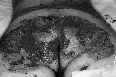 Fig. 2Multi-grafted burn from gluteal region.