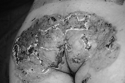 Fig. 3Post-operative result after three traditional autologous skin grafts.